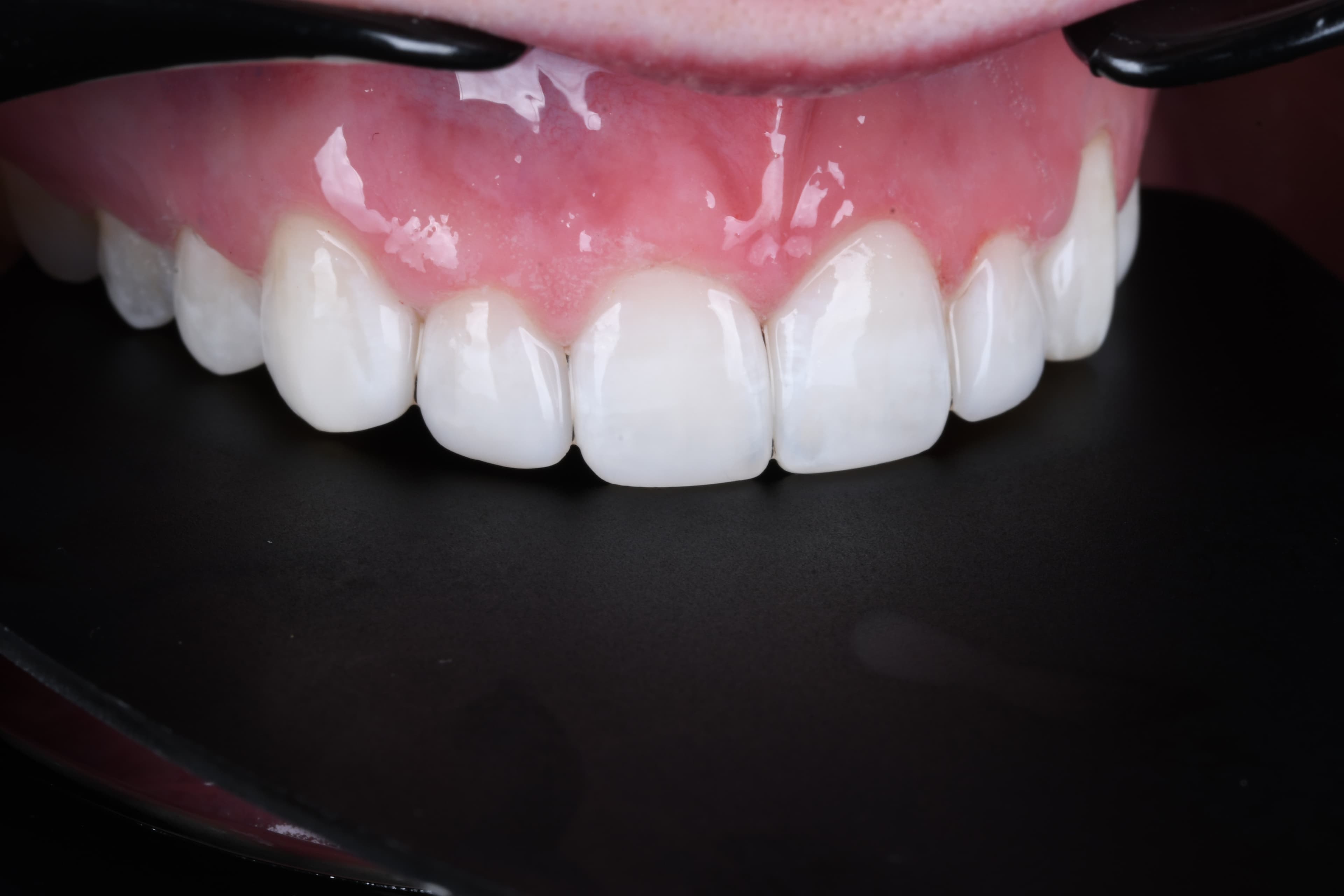 Chipped Tooth Repair — Seamless, Same-Day Fix — after