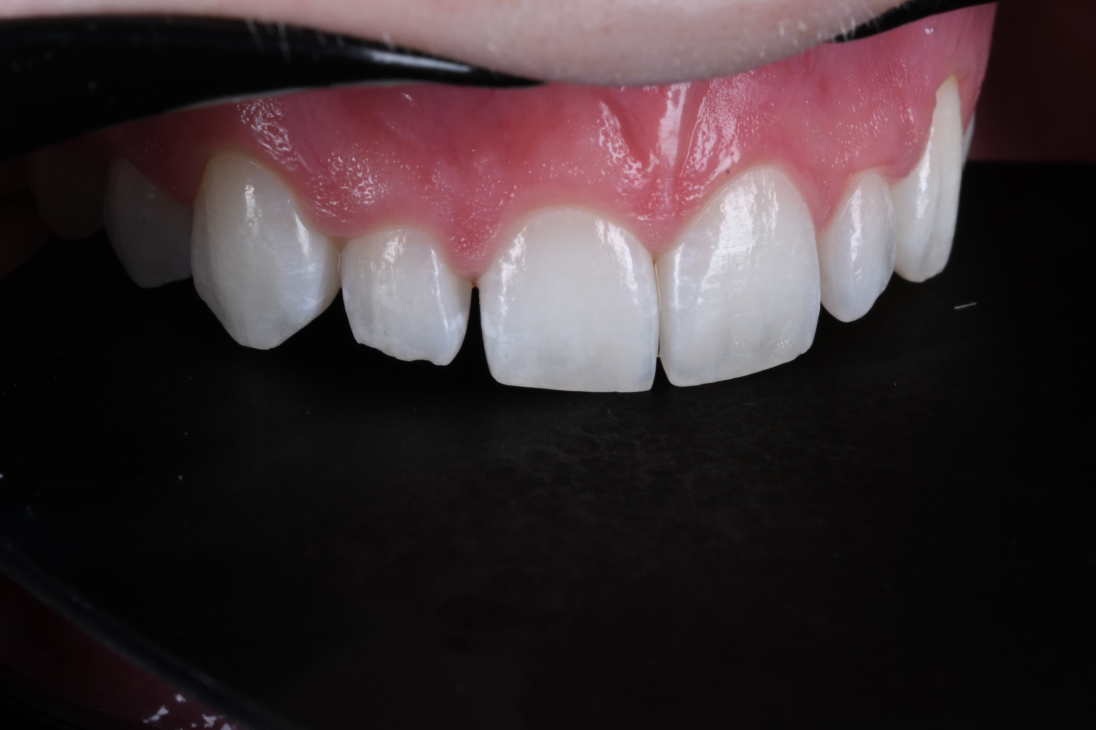 Chipped Tooth Repair — Seamless, Same-Day Fix — before