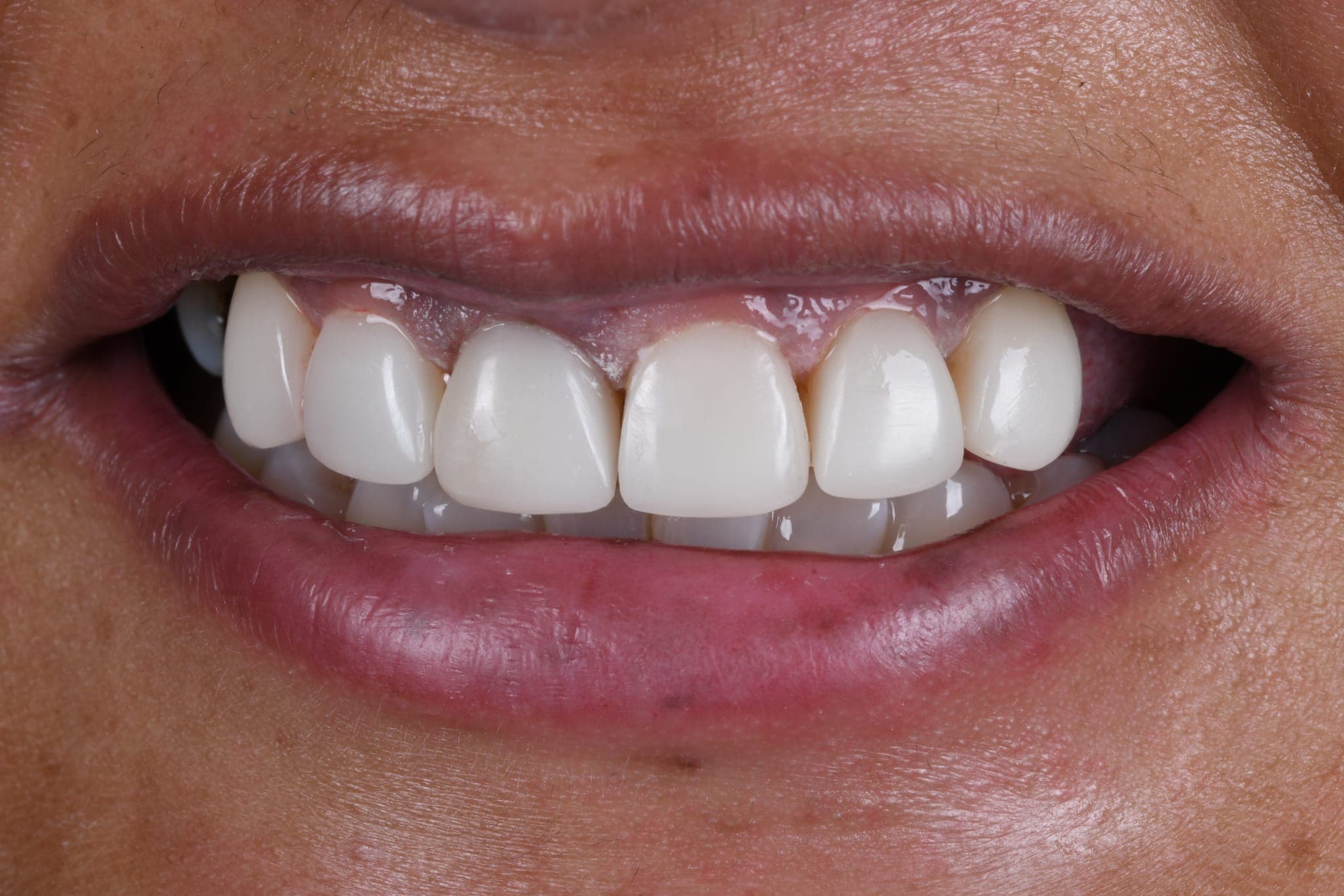 Discoloured Teeth — Bright, Natural Smile — after