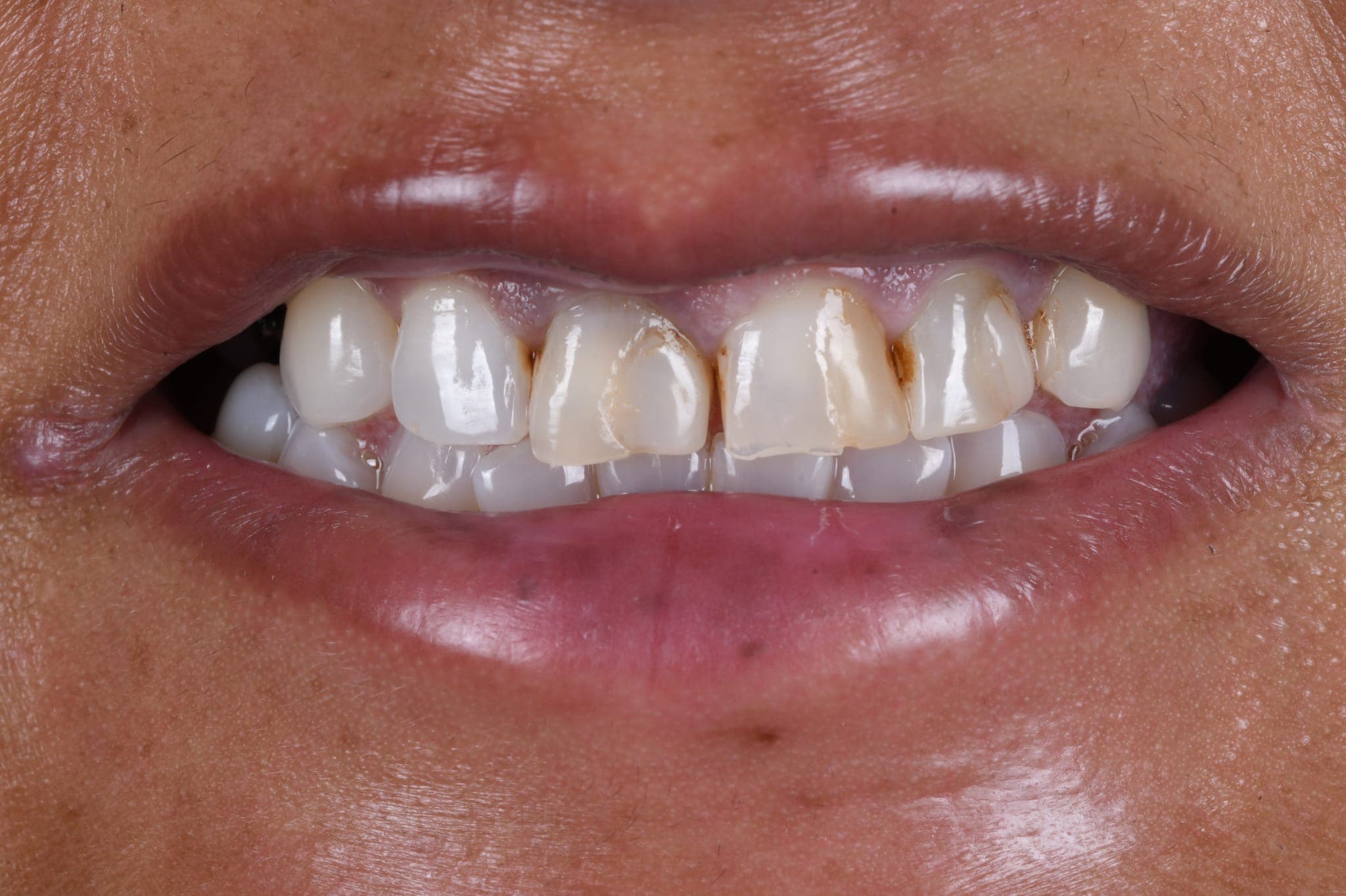 Discoloured Teeth — Bright, Natural Smile — before