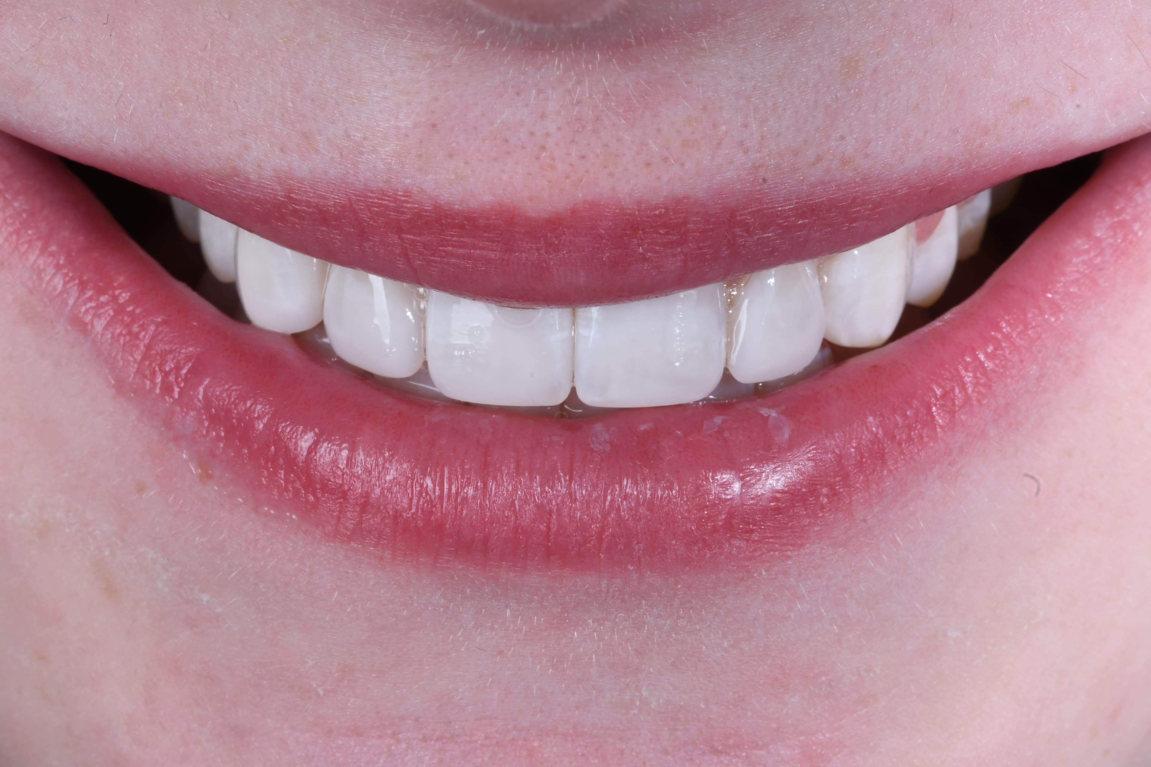 6 Teeth Composite Bonding — Edge Bonding & Contouring — after