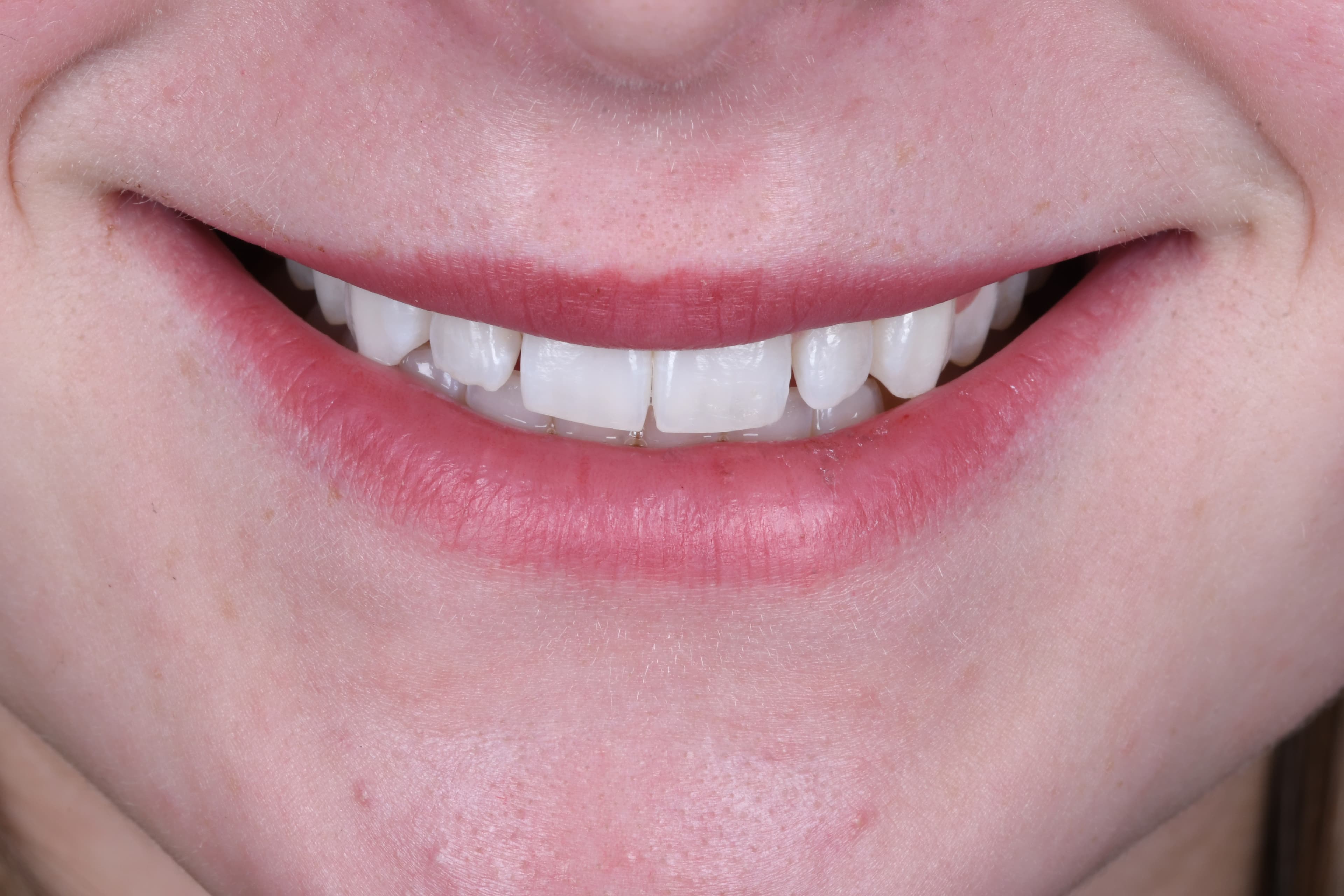 6 Teeth Composite Bonding — Edge Bonding & Contouring — before