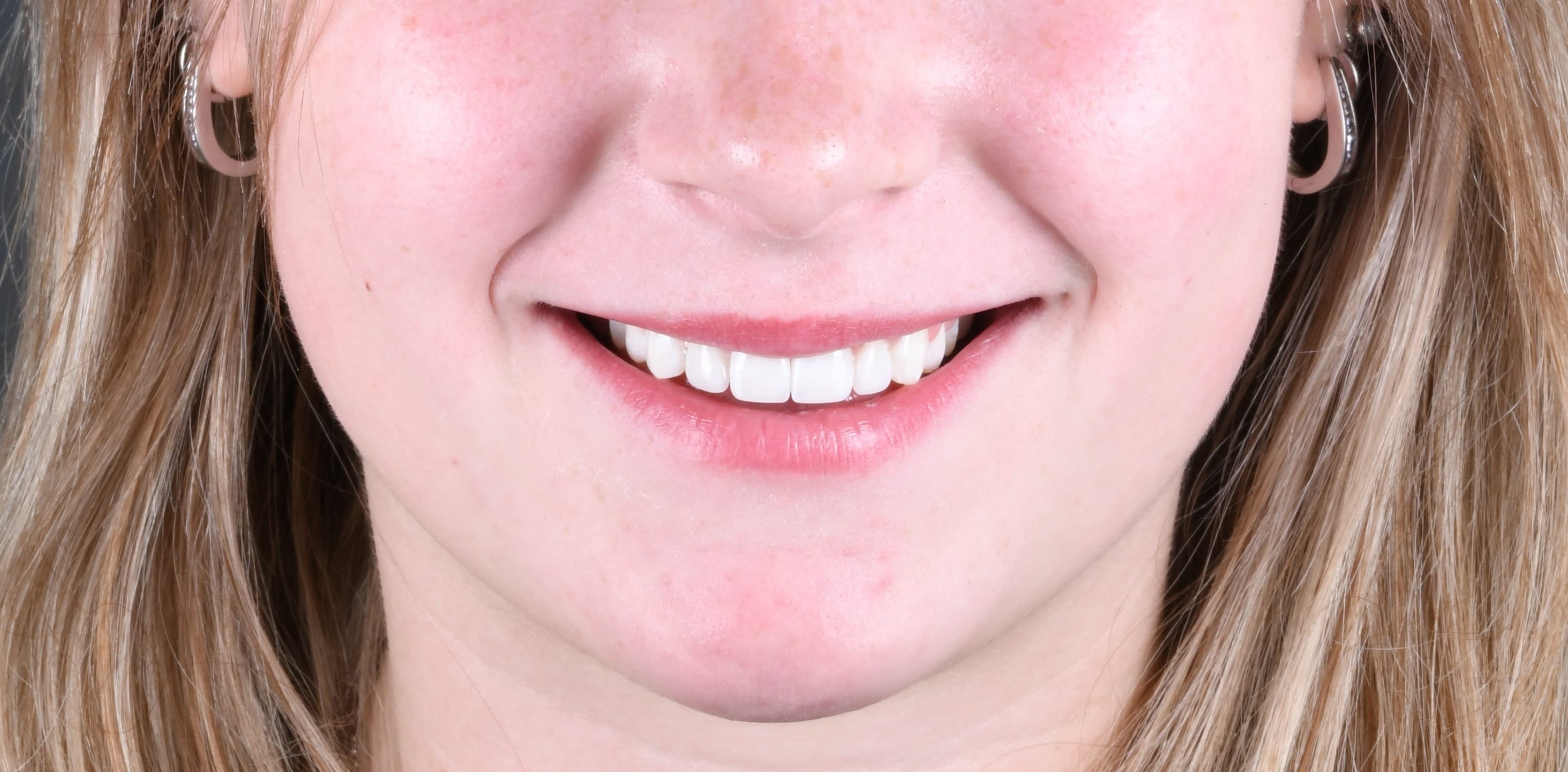 Real patient results — composite bonding — after