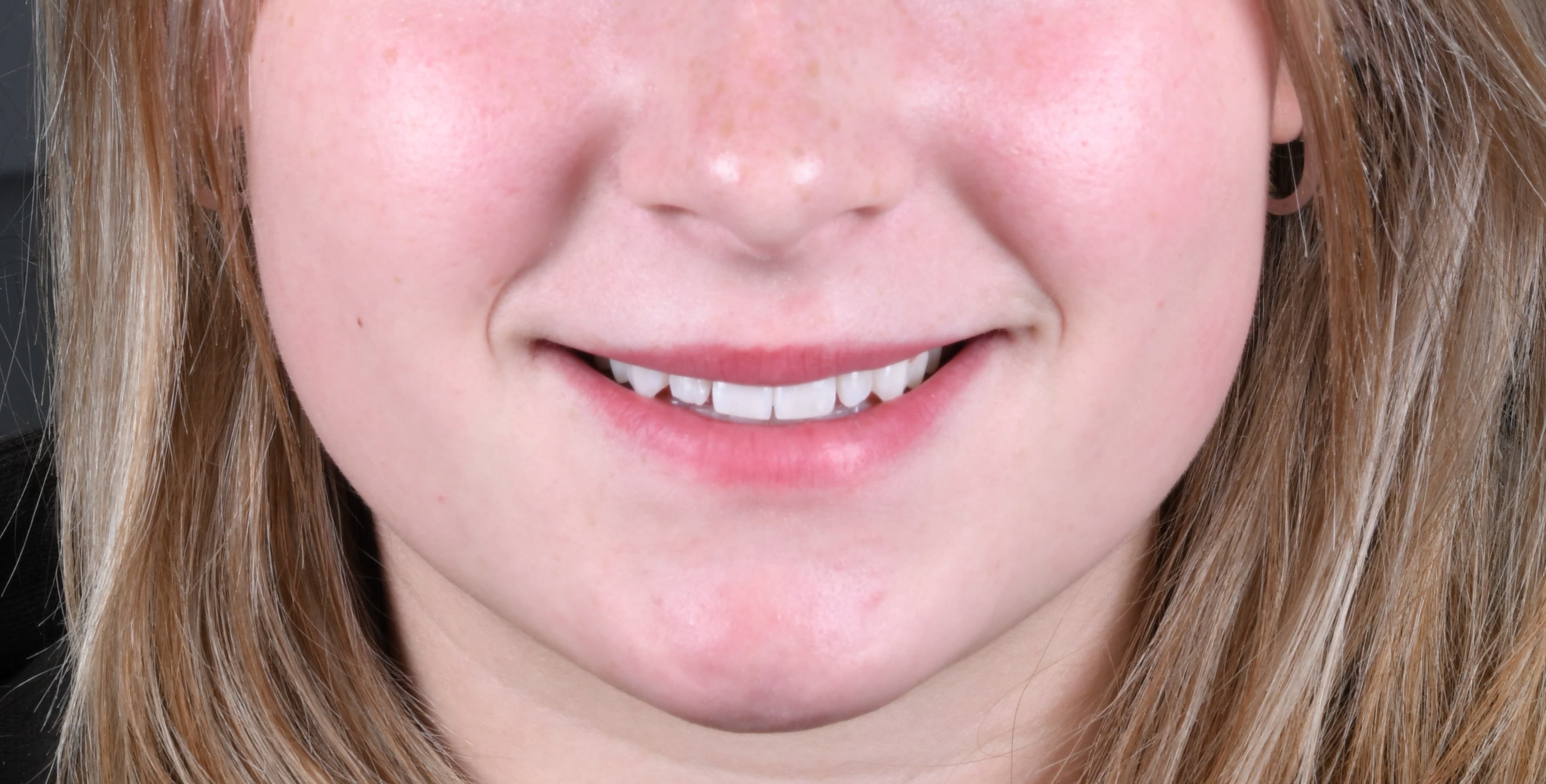 Real patient results — composite bonding — before