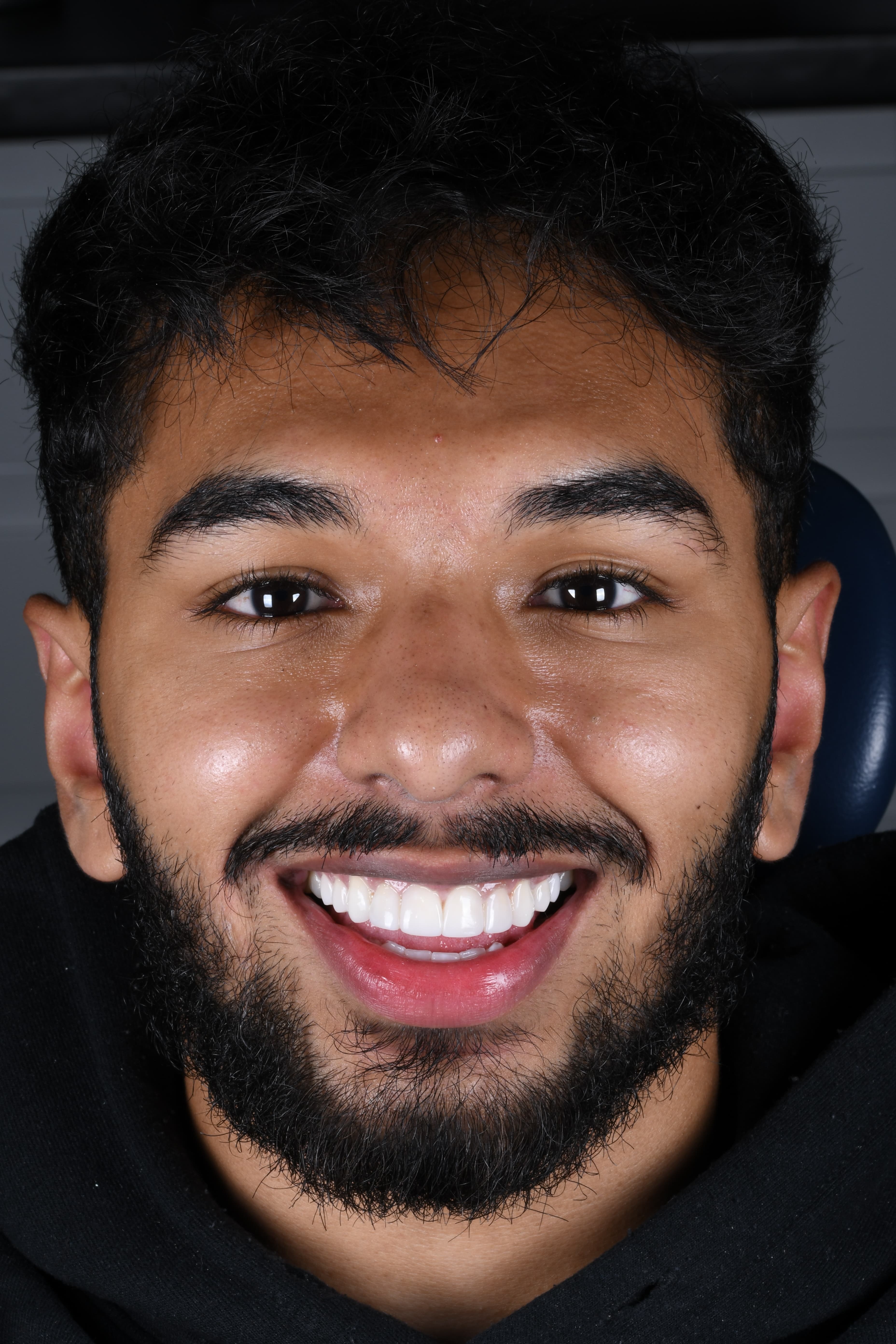 Chip & Gap Repair — Confidence Restored — after