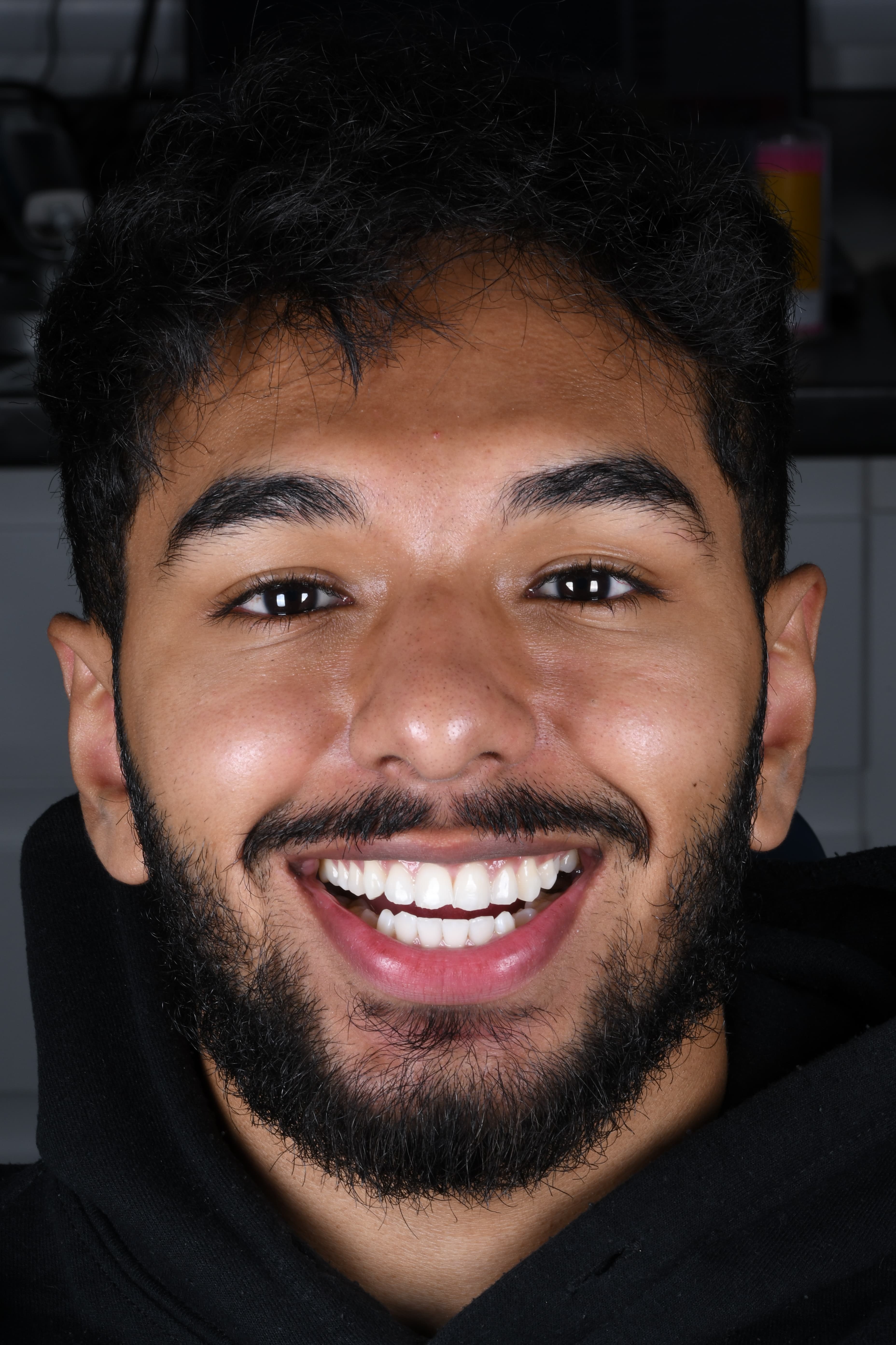 Chip & Gap Repair — Confidence Restored — before