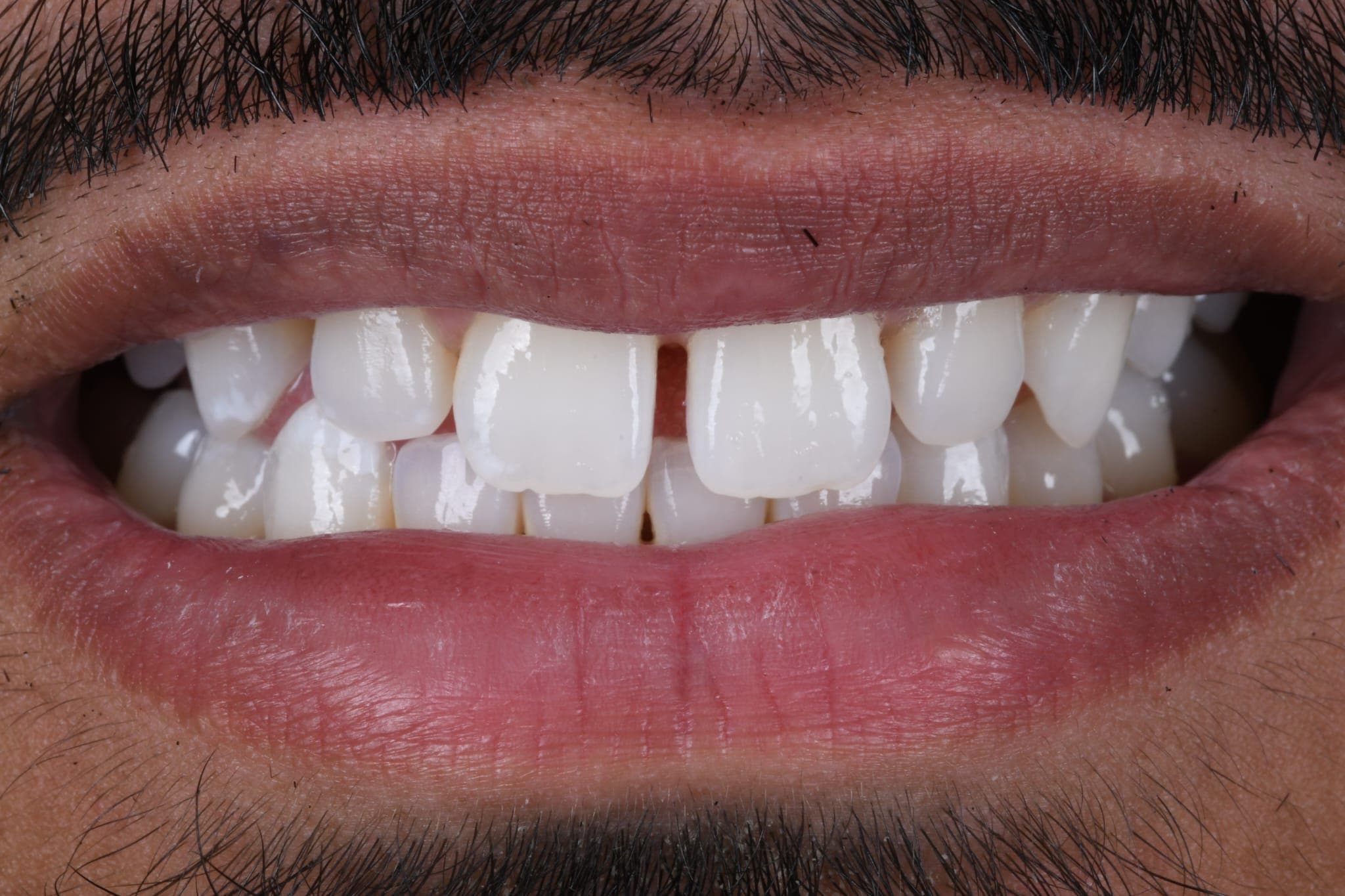 Gap Closure — Confidence Restored — before