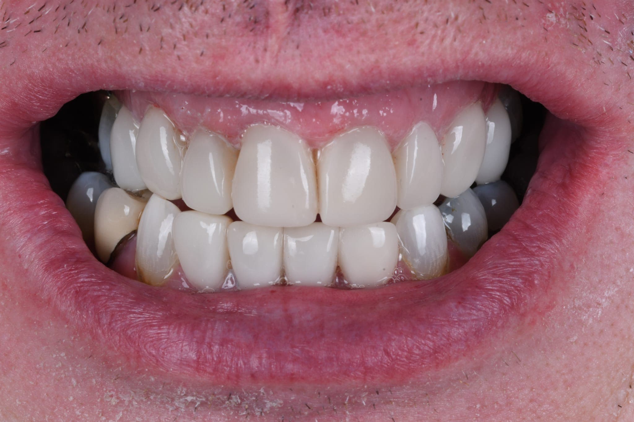 Full Smile Makeover — Composite Bonding — after