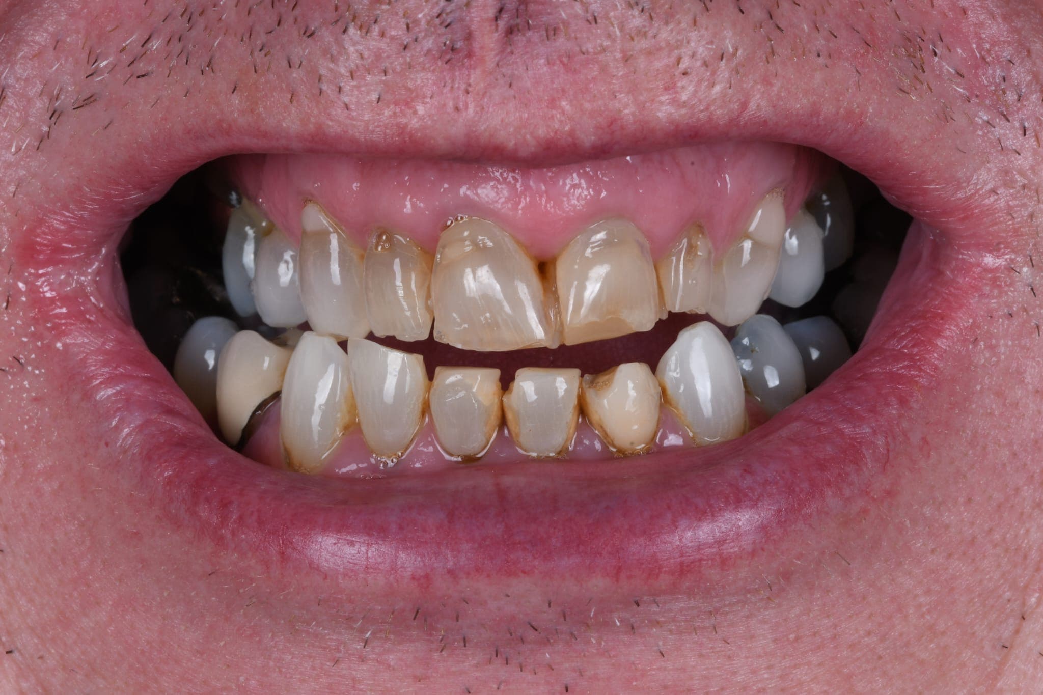Full Smile Makeover — Composite Bonding — before
